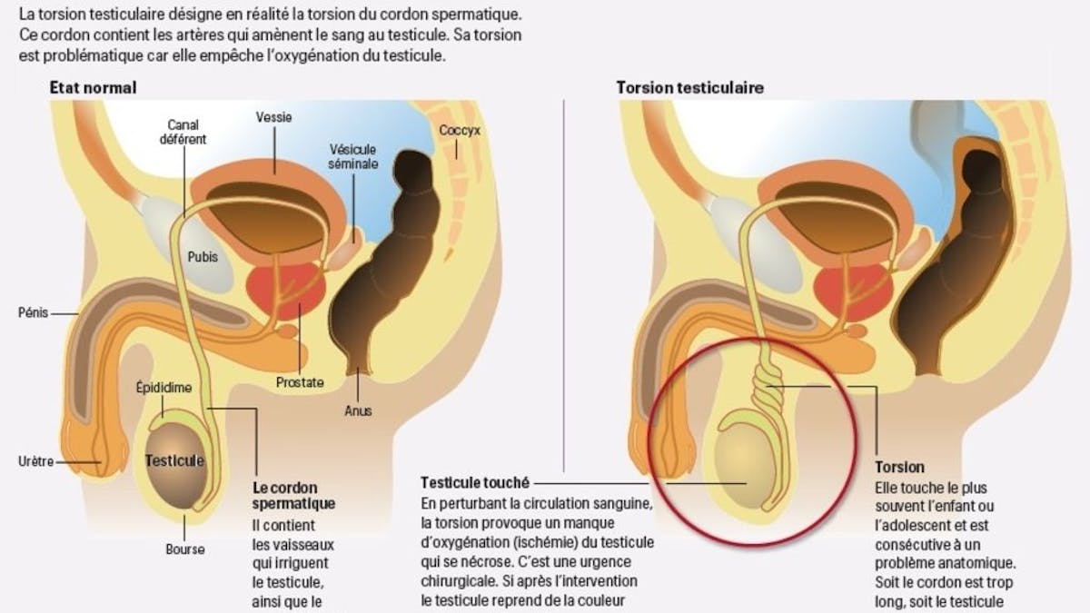 La torsion testiculaire nécessite une intervention en urgence ...